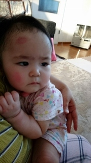 2016-4-24 顔に跡が付いてる (281x500).jpg